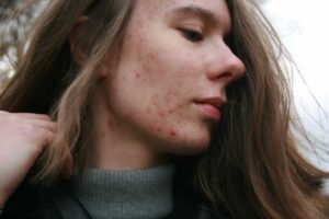 Skin inflammation and skin inflammation marks are not disappearing from your face, attempt these five simple techniques